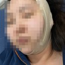 주식회사 명디자인플랜 | 이중턱 지방흡입 + 근육묶기 수술 후기(당일~3일차)