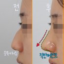 도도한의원 | 직반버선코후기 여성들이 선호하는 코라인, 직선코와 반버선코 차이!