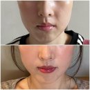 하나고주파 | 청담 튠페이스 고주파 리프팅 시술 후기