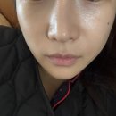 부스터서울 | 팔자주름 시술 고민일때 서울콜라겐부스터 후기