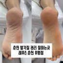 레푸스 춘천후평점 | 춘천발각질 관리 잘하는곳 레푸스 춘천 후평점 후기