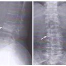 압박골절(Compression Fracture) 이미지