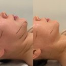 계룡고등학교 | [계룡 고운율] 새로 도입된 리프팅 기계로 턱 라인, 이중턱 소멸 한 슈퍼리스팅 솔직 후기