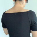 등드름 모공각화증 치료 비용과 후기