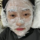 압구정 피부과 여드름흉터치료 e2레이저 1회 효과, 후기