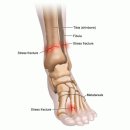 골드정형외과의원 | 피로골절, 방치하면 안 되는 이유 - 미금본닥터정형외과 수부외과 전문의가 알려드립니다