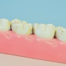 새미소치과의원 | 대전 둔산동 치과에서 받은 사랑니 발치! 아팠지만 후회는 없어요 ft. 꼼꼼 관리 후기