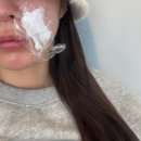 강남역 피부과 팔자주름 시술 쥬베룩 볼륨 후기 만족