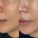 레아 | 평택 고덕 슈퍼젝션 라운지오레아 앰플관리 솔직후기