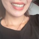 달서구 치아미백 후기 하루만에 A2에서 A1 톤 변화, 달서구 치과 추천, 대구 치아미백