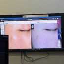 직화정 | 일산 리팟레이저 흑자 제거 후기｜화정역 피부과 내돈내산 Before & After