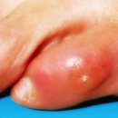 봉와직염 (Cellulitis)의 원인. 증상. 치료 이미지