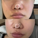 밝은마음한의원 | 상계피부과 한의원 코 흉터제거 치료 1회차 새살침 후기