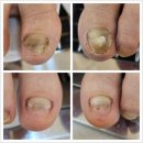 페디네일 이미지