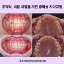 연세바로치과교정과치과의원 | 신중동 교정치과 주걱턱과 비뚠 치열 개선을 원한 중학생 교정 사례