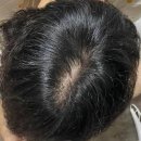 자혜로 | 부산자혜내과 후기 및 탈모관리방법