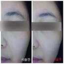 지앤미피부과의원 | 피부과전용필링 #부스터필 #아이필