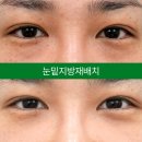 아이케이성형외과의원 네이버블로그