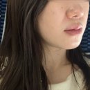 분당-365 | 분당피부과에서 스킨보톡스 + 올리디아 365 볼륨부스터 대만족 후기