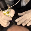 클라스웰정형외과의원 | 용인 죽전 병원에서 진행되는 SMP 두피문신 정수리 가르마 커버 전후사진