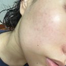 메디큐브의원 | [메디큐브] 부스터프로 미니 입문용 뷰티디바이스 내돈내산 후기 (예민피부 부작용, 피부염)