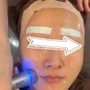 티타늄리프팅 효과,가격,듀얼티타늄 전후 변화 (+엑실리스 명품 패키지)