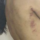 팔조지 | 부산 팔, 등 지방흡입 한 달 차 후기(재봉합, 후관리, 라인)