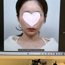 반니성형외과의원 | 반니 성형외과 내돈내산 후기/ 리투오, 관자놀이 필러 후기/쥬비덤 볼루마/마취크림/무수면