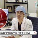 혹처럼 튀어나온 이마 지방종, 이마 종양 흉터 없이 제거하는 방법