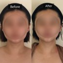 분당 미금역 윤곽관리 듀에스떼 에스테틱 강추 피부+윤곽+비대칭까지 케어 후기 (비교사진O)