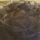 딩동 | 커클랜드 미녹시딜 5% 내돈내산 5개월 사용후기: 정수리 '딩동' 놀이가 부른 참사