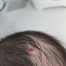 레이져 | 청주 신생아 혈관종 보험 레이져치료 후기