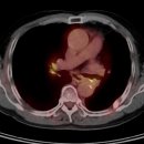 폐암 수술 후 재발암의 방사선치료 Lung cancer 이미지