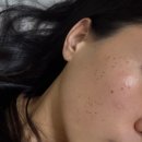 루비뷰티 | [뷰티] 루비레이저, 아꼴레이드 시술 1주후기