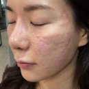 분당예쁨주의쁨의원 | [분당역 피부과 후기] 예쁨주의쁨 분당점 필로드 2cc &amp; 프락셀 나비존 시술 내돈내산 후기