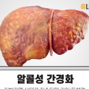 알콜성 간경화 초기 원인, 간경화 말기 과 진단 방법은? 이미지