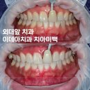 이데아치과의원 | 외대 원데이 치아미백 커피로 착색 된 치아 국형용 원장님 후기