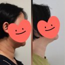 생성-자연 | 안양범계 이중턱 윤곽주사, FDA 허가 받은 dca 밉살주사가 정답! 직접 맞아본 지방파괴주사 후기