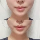 뉴하이에스노동조합 | [메디큐브 뉴 하이포커스 샷 내돈내산 구매후기] 🌟 울쎄라 대신 땅콩형 얼굴 예방하는 디돌이야의 윤곽...