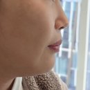 스타피부과의원 | 신사동1번출구 피부과의원 온다리프팅으로 나의 이중턱 탈출 후기