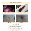 만성담낭염수술후기. 김정윤 원장님의 친절한 설명, 수술하는 영상까지 세세히 보여주시니 너무 믿음이... 이미지