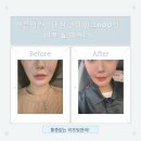 프렌즈의원 | 앤봄의원홍대점에서 쿨페이즈600샷 받고 얼굴 리프팅된 후기 !