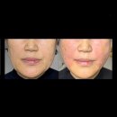 맘편한한의원 | 인천 구월동 실리프팅 포메디한의원 60대 엄마 매선 실리프팅 후기!