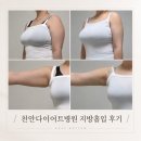 씨유천안신부스타점 - 4821 | 천안다이어트병원 팔뚝지방흡입 20일차 변화 후기ㅣ천안지방흡입 회복 과정
