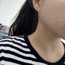 청담포레브의원 | [청담] 청담포레브의원 : 티타늄리프팅 , 더브이 티타늄 후기 청담피부과