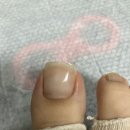 은평구 녹번동 내성발톱 마이네일 케어 한 달 후기