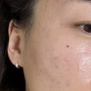 카프리 | 김해근교 마산피부과 여드름 레이저 잘하는 곳 추천 카프리 레이저 솔직후기
