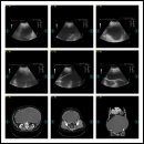 cystadenoma vs cystadenocarcinomas. 이미지