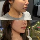 강남역 피부과 튠페이스 듀얼튠 후기 (80kj 솔직 효과)