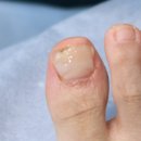 어딕션 | 부천 네일샵 내성발톱 관리! 비포애프터 후기(디에고푸스 어딕션네일)